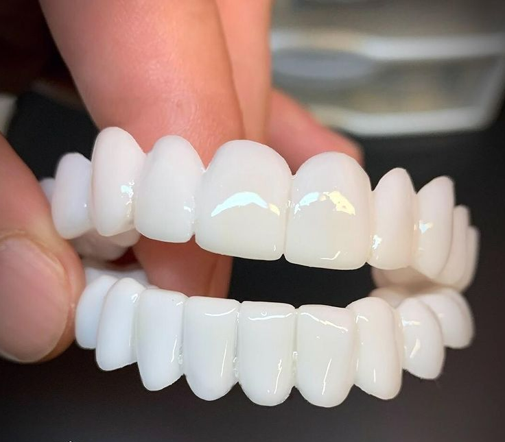 DentAlign Resin Dental Veneers, Reusable and Easy to Apply and Remove