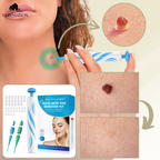 DermaLinx Wart Remover for Home Use for Face, Neck, Hands and Feet, view 6