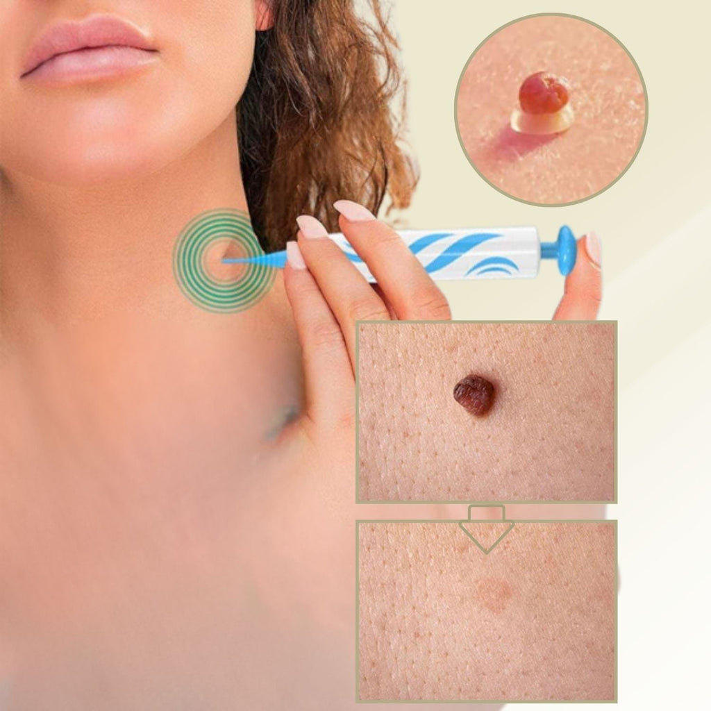 DermaLinx Wart Remover for Home Use for Face, Neck, Hands and Feet