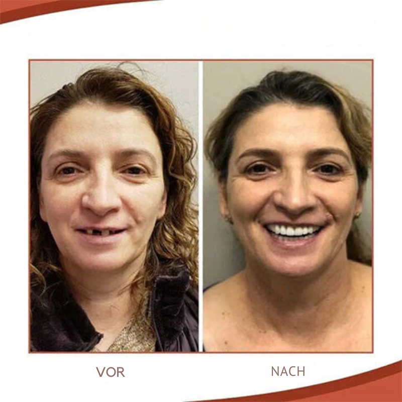 Realistic temporary dental filling strips for upper and lower teeth