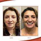 Realistic temporary dental filling strips for upper and lower teeth