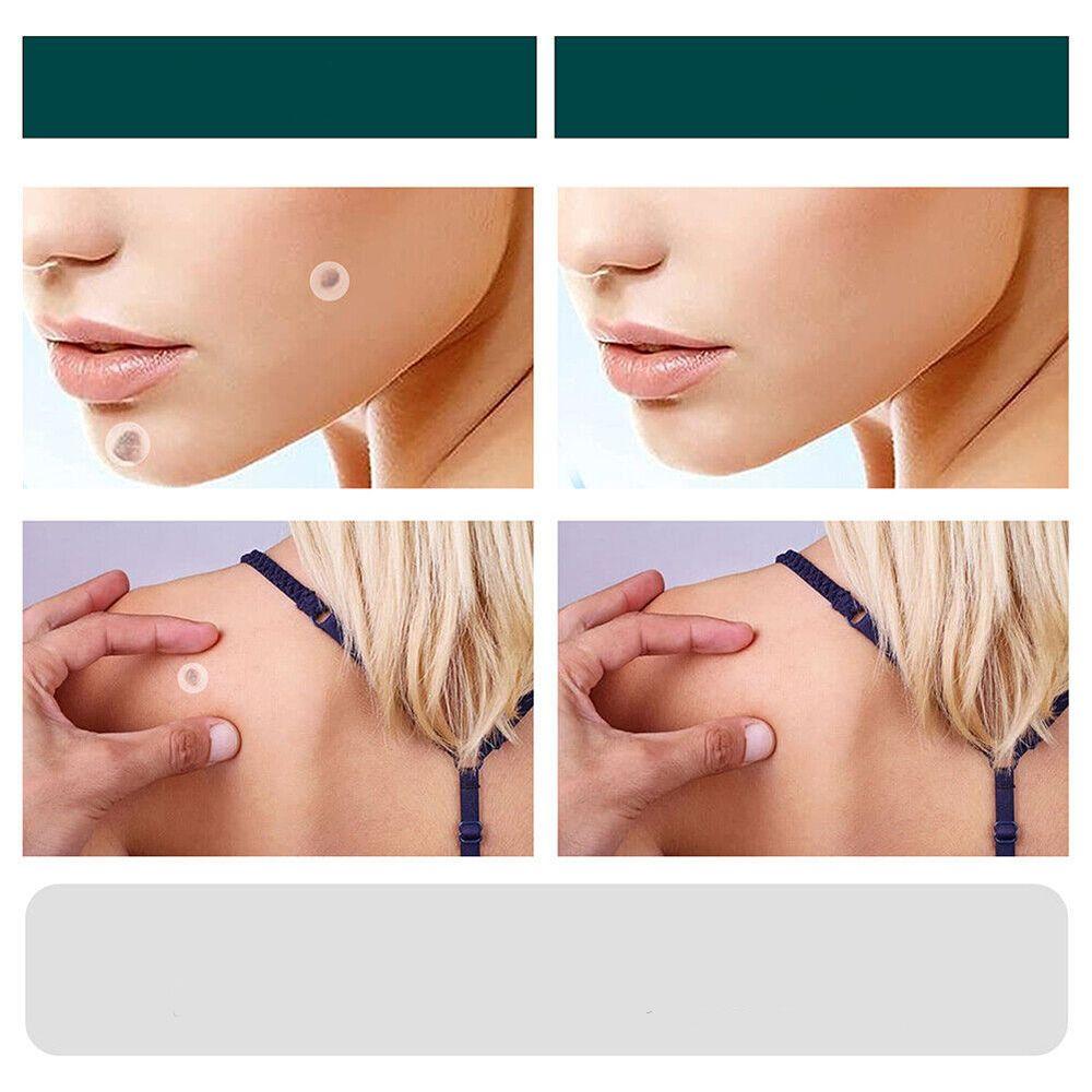 SkinClear Skin Patches for Spots and Warts, 120 Pieces, view 6